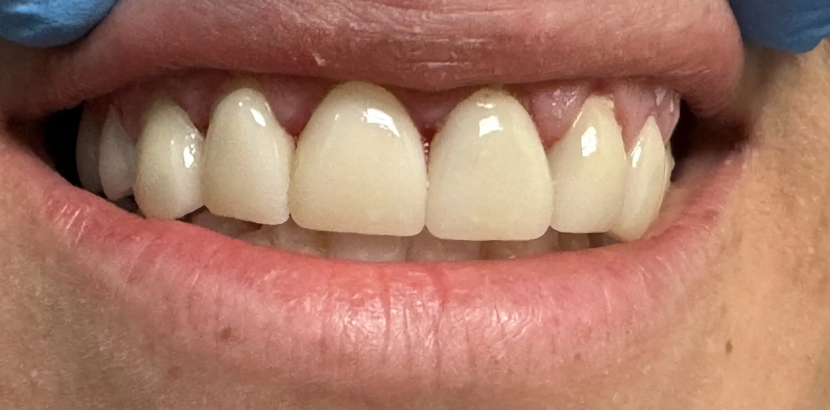 Patient smile after treatment, case 1