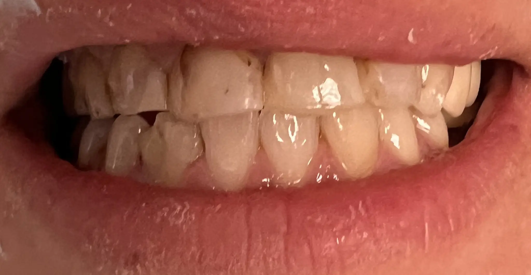 Patient smile before treatment, case 1