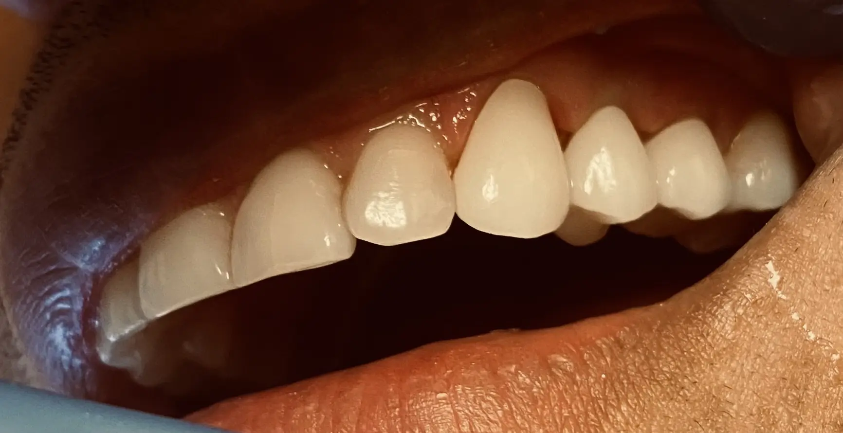 Patient smile after treatment, case 2