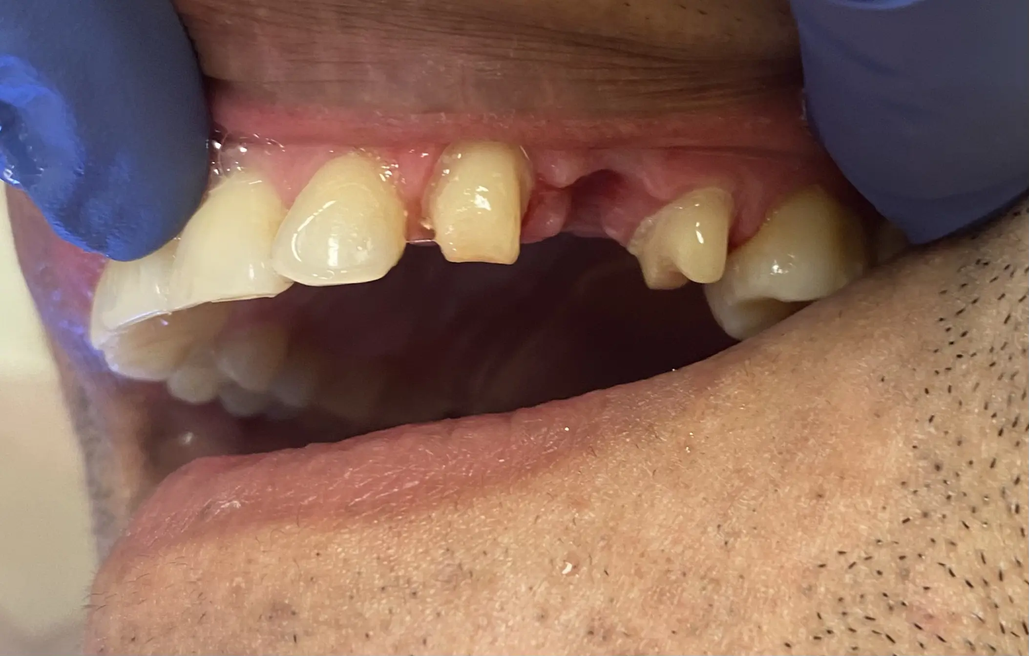 Patient smile before treatment, case 2