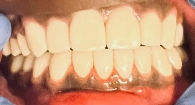 Patient smile after treatment, case 3