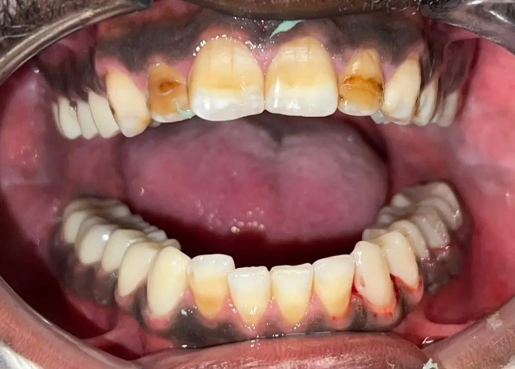 Patient smile before treatment, case 3