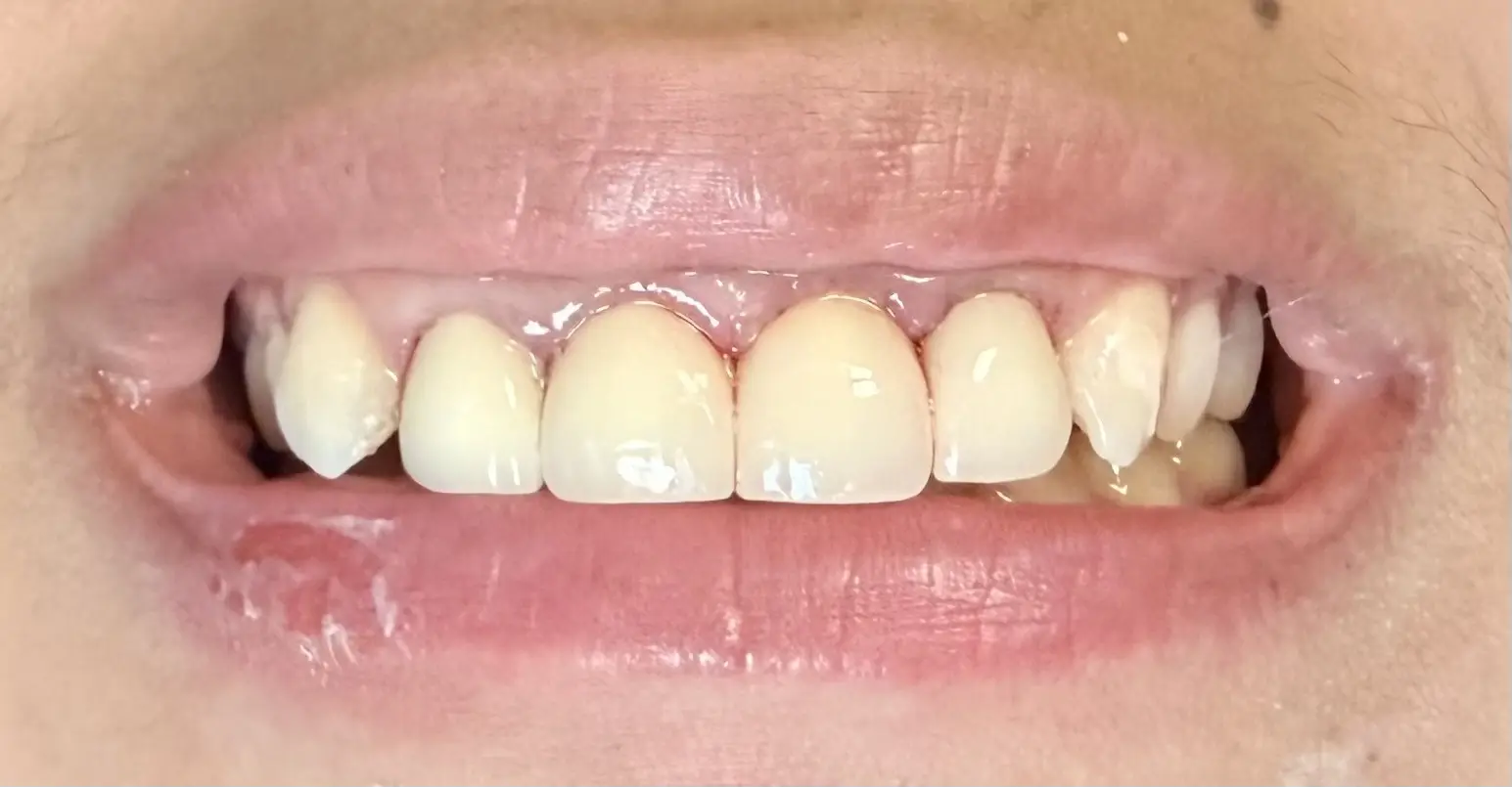 Patient smile after treatment, case 4