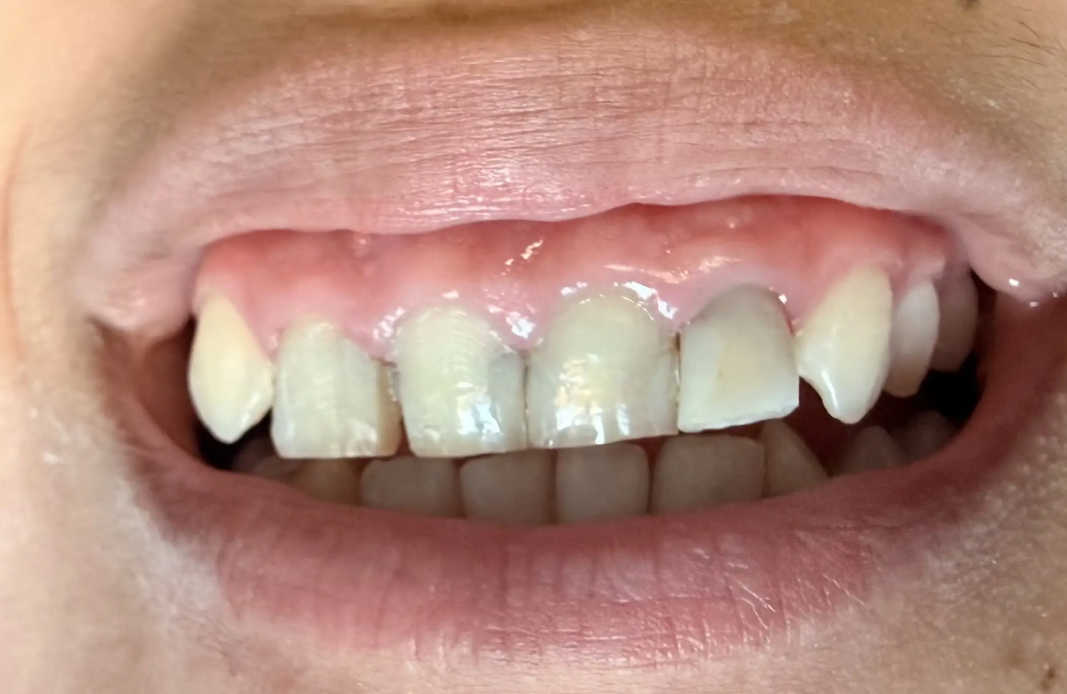 Patient smile before treatment, case 4