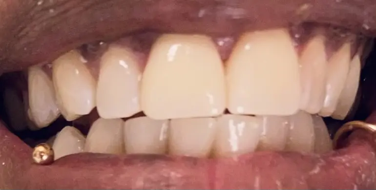 Patient smile after treatment, case 5