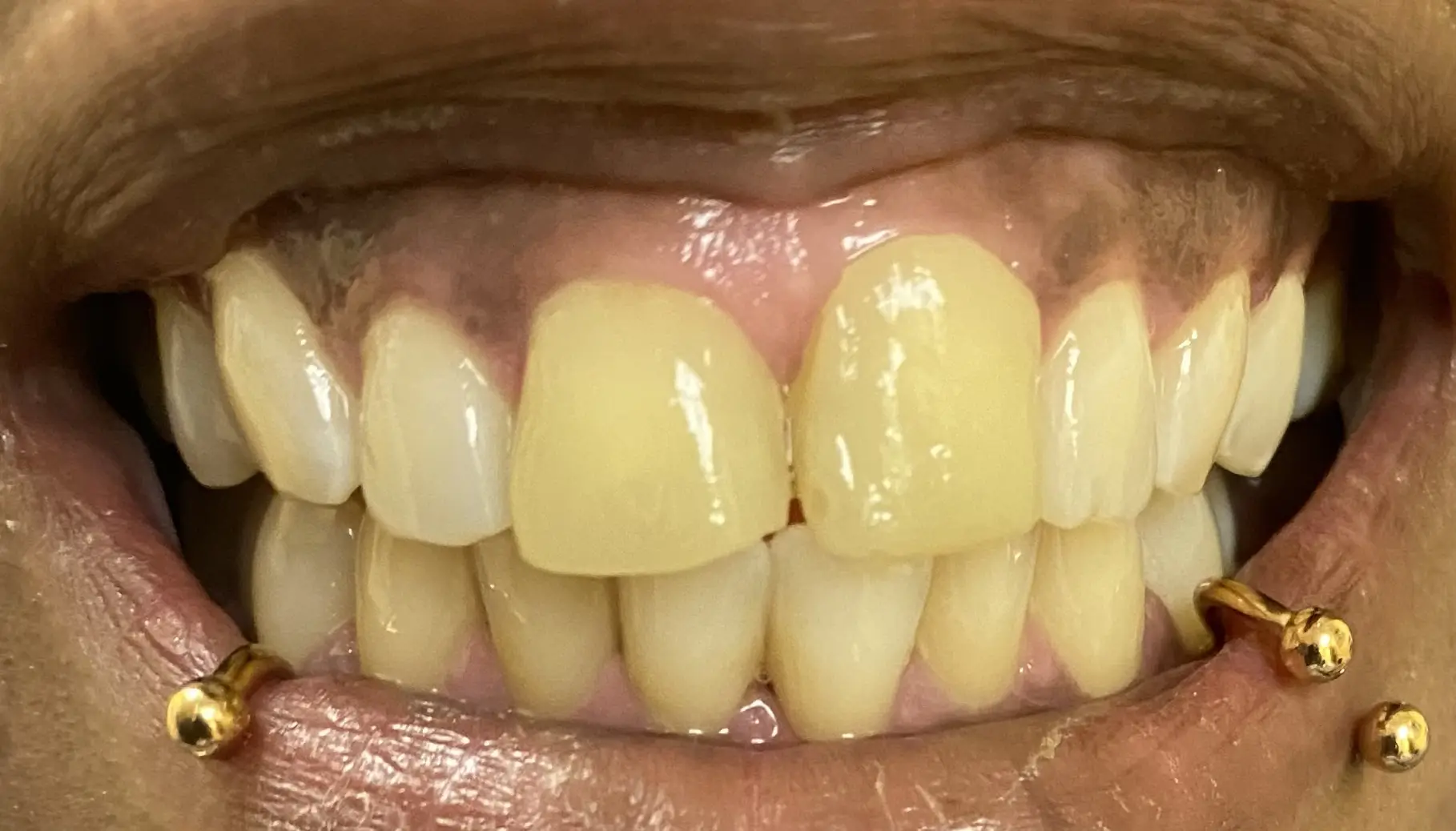 Patient smile before treatment, case 5