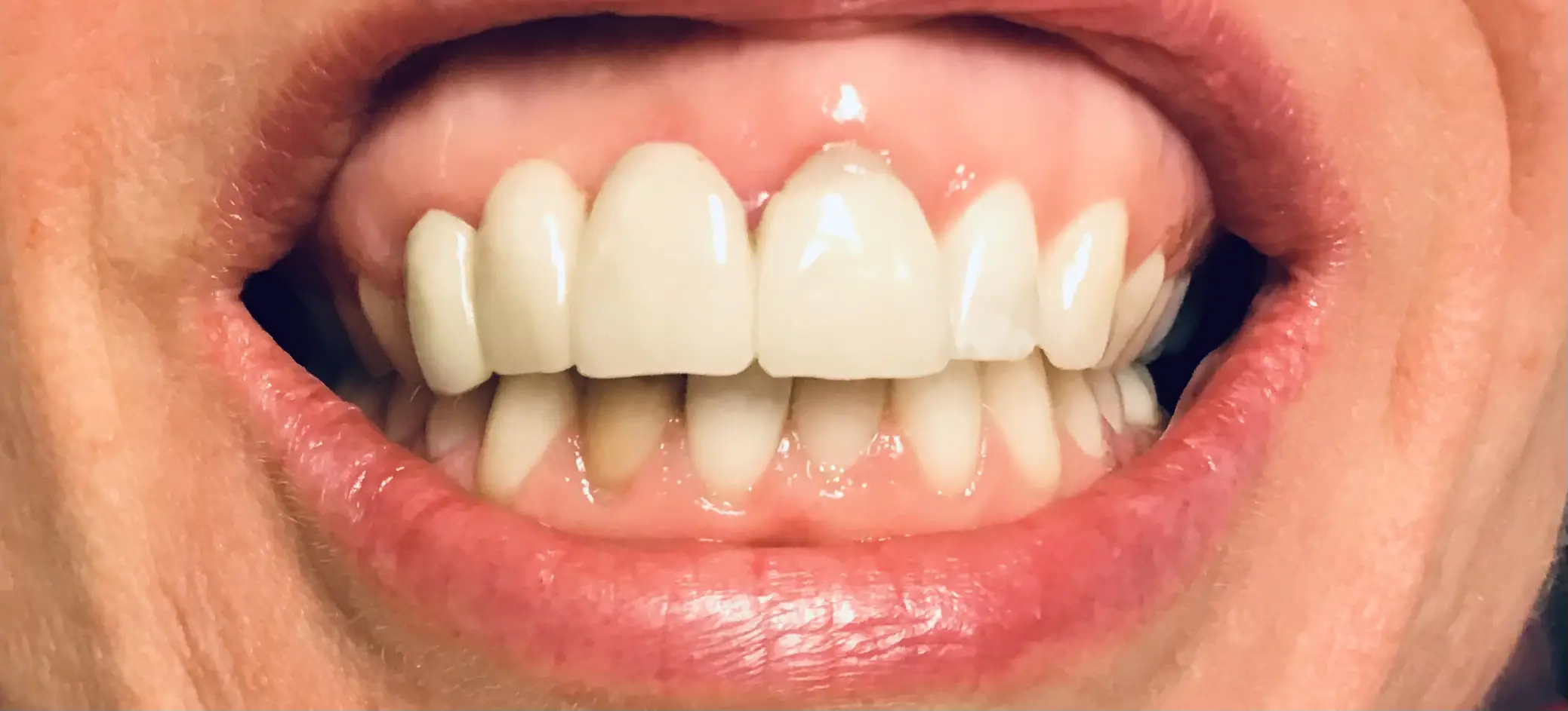 Patient smile after treatment, case 6