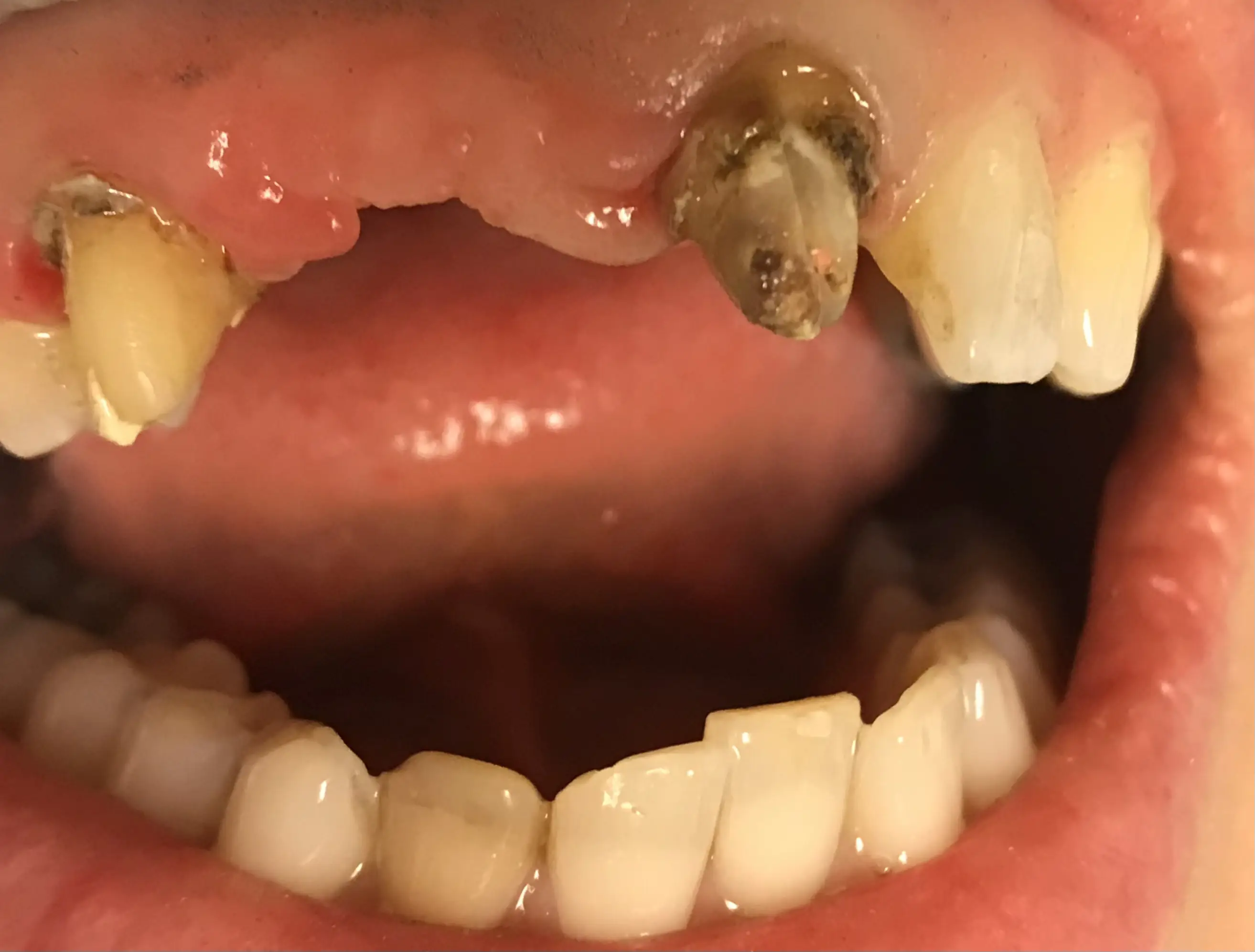Patient smile before treatment, case 6